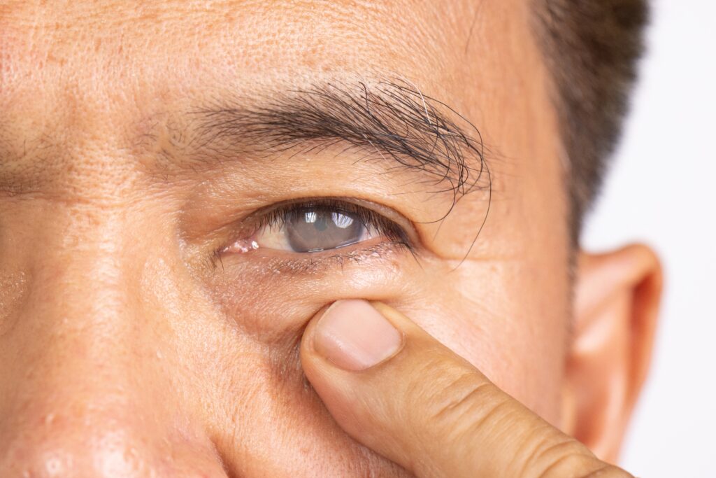 Rhinoplasty