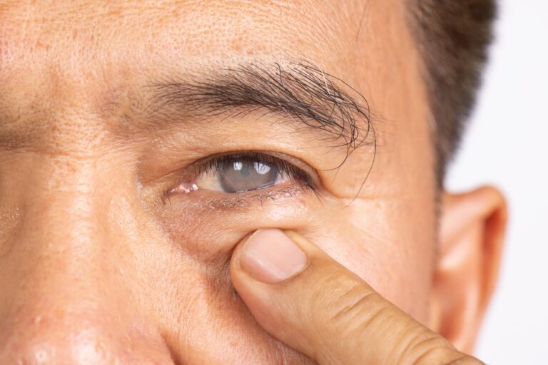 Rhinoplasty